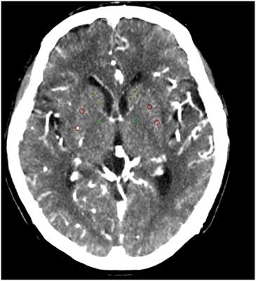 Correlation Between the Number of Lenticulostriate Arteries and Imaging of Cerebral Small Vessel Disease